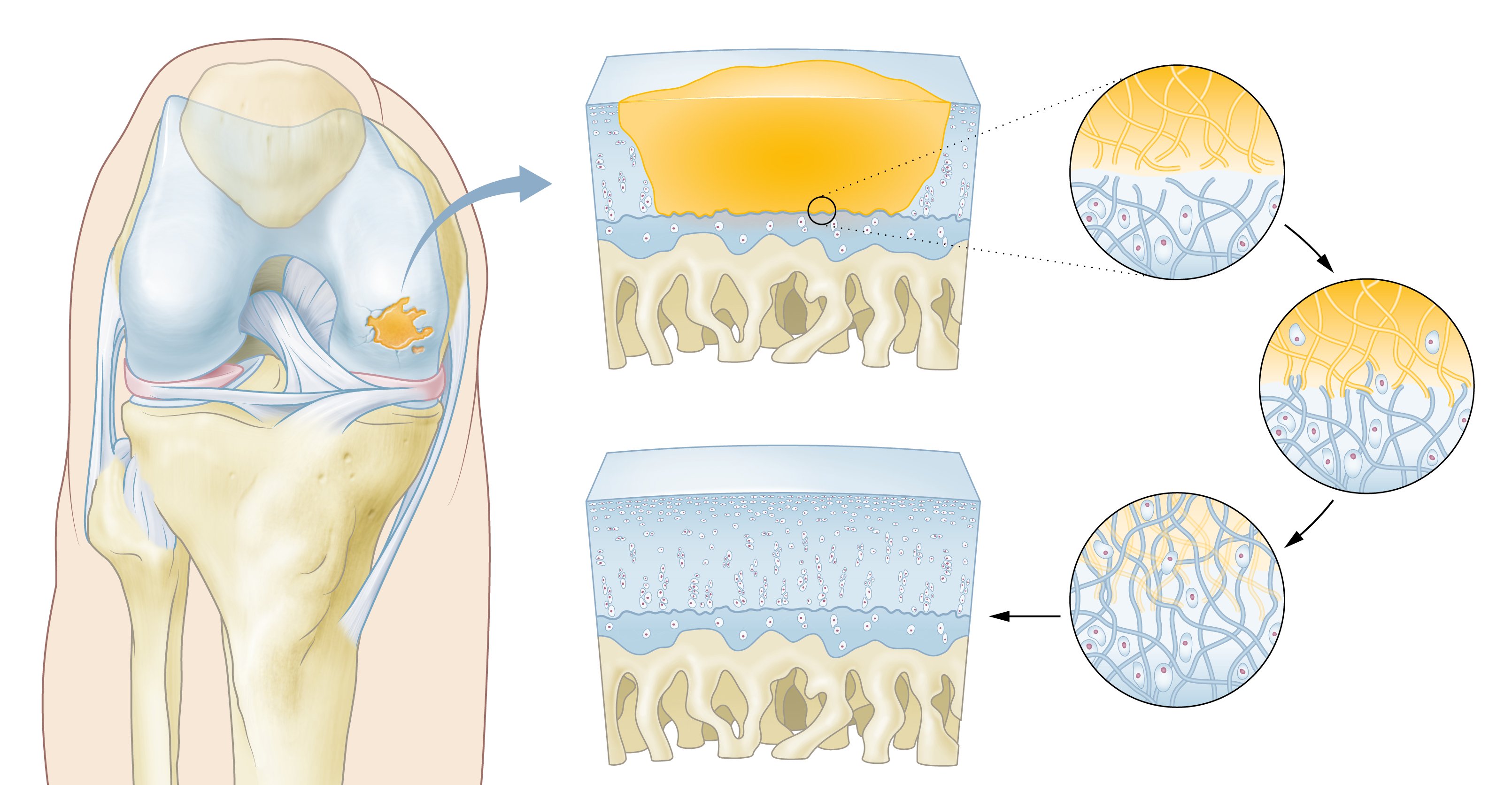 Hy2Care  - Hy2Care's CartRevive® hydrogel implantaat