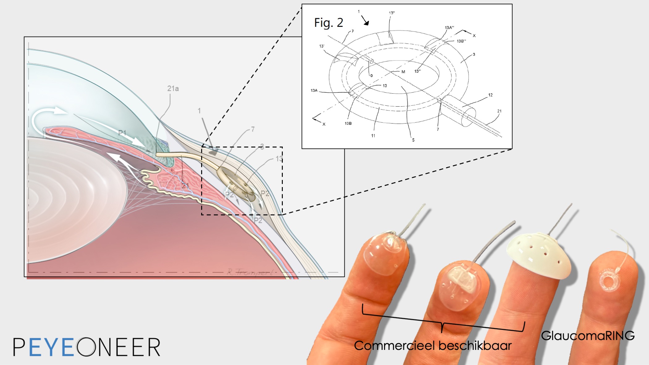 PEYEONEER Ophthalmic Solutions BV - GlaucomaRING
